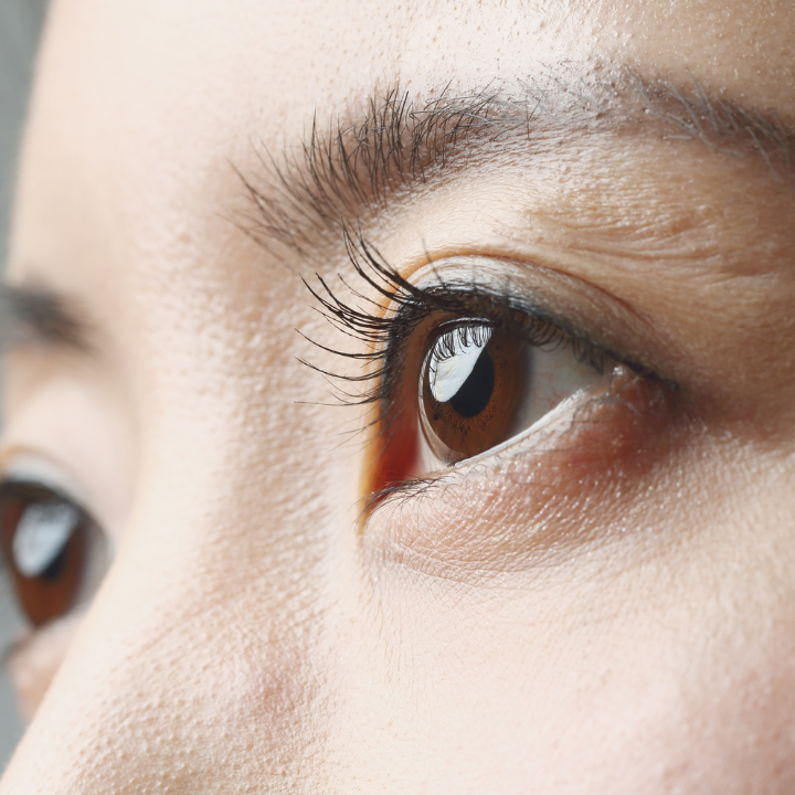 Understanding the Causes of Under-Eye Circles & Bags