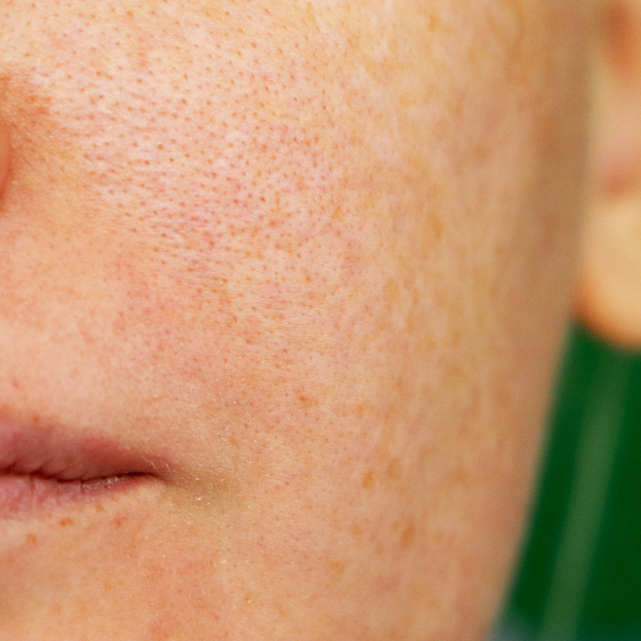 How Diet & Lifestyle Affect Pore Size