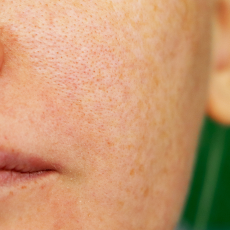 How Diet & Lifestyle Affect Pore Size